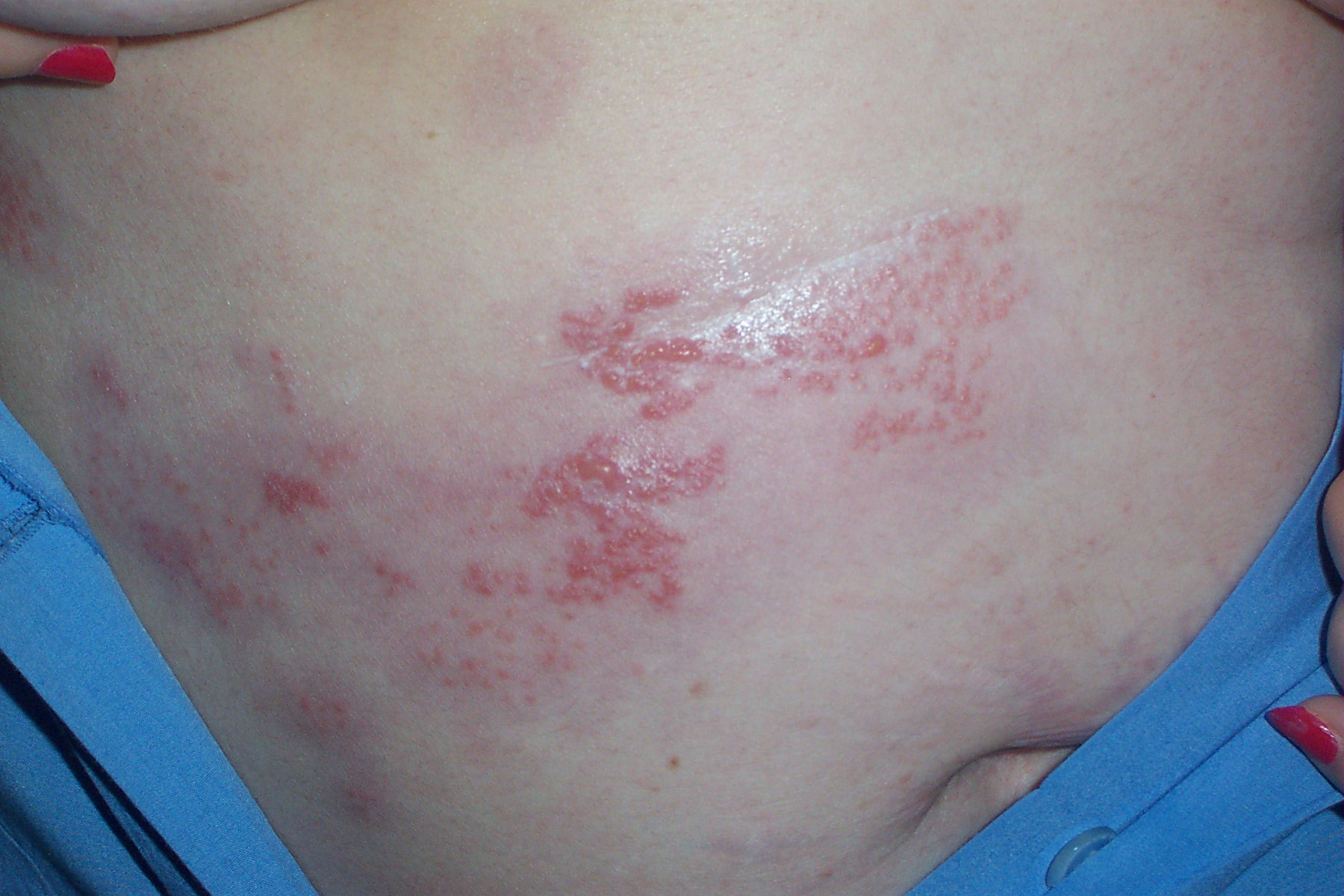 Lesiones de herpes zoster en una paciente en tratamiento quimioterapico